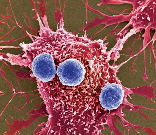 A New Cancer Treatment That Is Faster, More Efficient and Less Risky Is Coming: Bacteria Bombs A New Cancer Treatment That Is Faster, More Efficient and Less Risky Is Coming: Bacteria Bombs