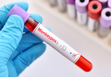 Monkeypox: Everything You Need To Know Monkeypox: Everything You Need To Know