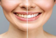 Laser Teeth Whitening in Islamabad: Discover the Key to a Brighter Smile Laser Teeth Whitening in Islamabad: Discover the Key to a Brighter Smile