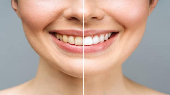 Laser Teeth Whitening in Islamabad: Discover the Key to a Brighter Smile
